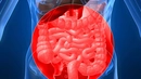 Bağırsak Tümörü Belirtileri ve Tedavisi Bağırsak Tümörü Belirtileri ve Tedavisi