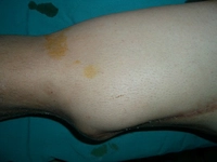 Bacakta Tümör Belirtileri ve Tedavisi Bacakta Tümör Belirtileri ve Tedavisi