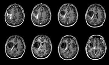 Beyinde İyi Huylu Tümör? Beyinde İyi Huylu Tümör?
