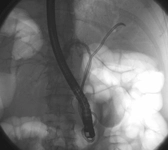 Klatskin Tümörü Belirtileri ve Tedavisi Klatskin Tümörü Belirtileri ve Tedavisi