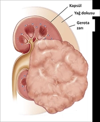 Böbrek Tümörü Belirtileri ve Tedavisi Böbrek Tümörü Belirtileri ve Tedavisi