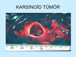 Karsinoid Tümör Belirtileri ve Tedavisi